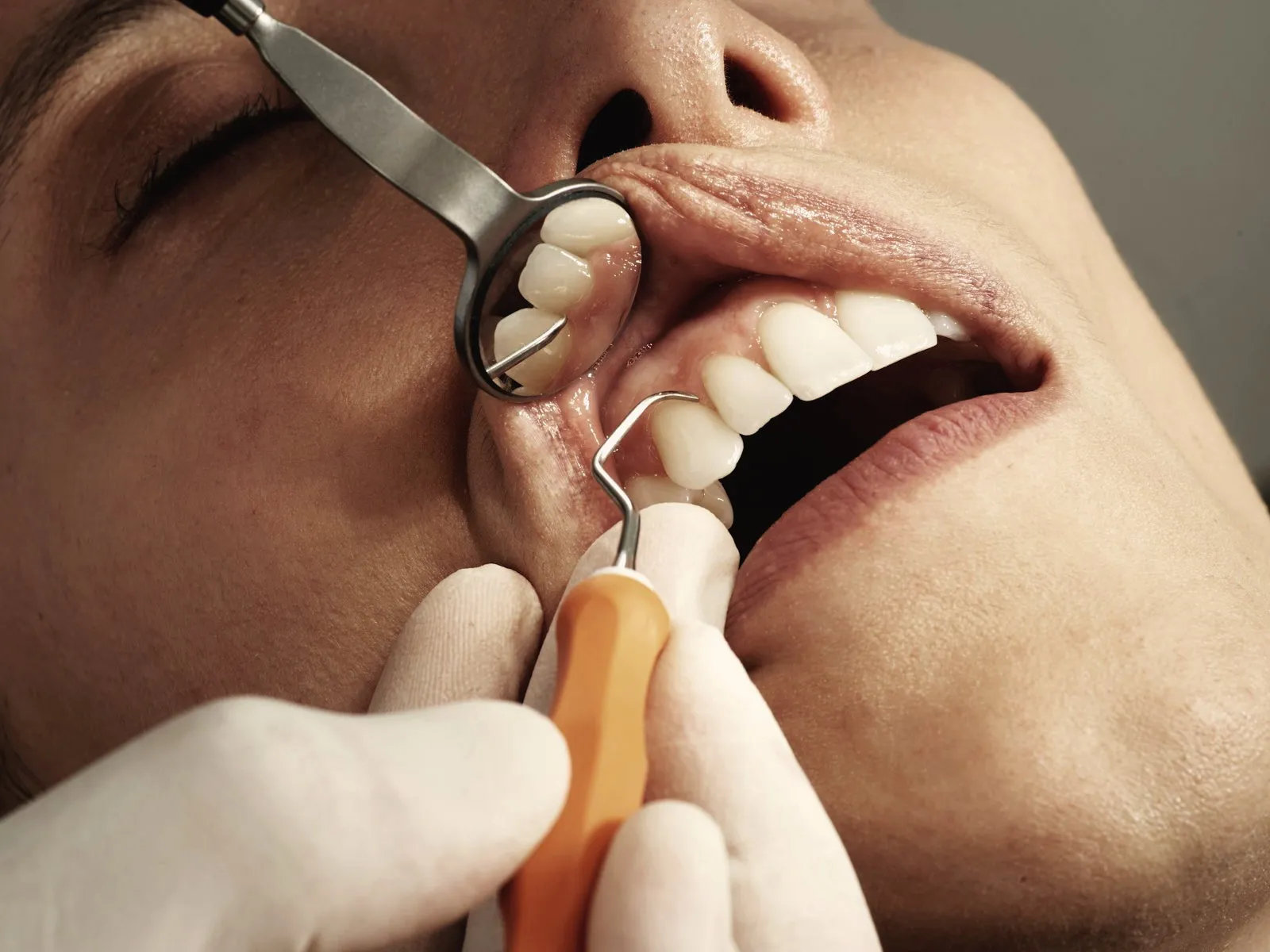 Dentist carefully shaping and polishing composite bonding on a front tooth